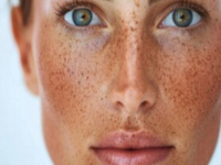 sunspots-treatment-fort-collins-brighten-and-even-skin-tone