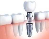achieve-a-radiant-smile-with-san-diego-teeth-whitening