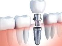 achieve-a-radiant-smile-with-san-diego-teeth-whitening