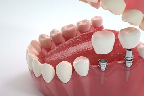 cheap-implant-in-northeast-philadelphia-big-0