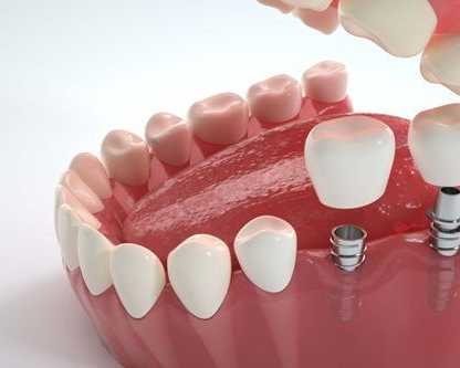 cheap-implant-in-northeast-philadelphia