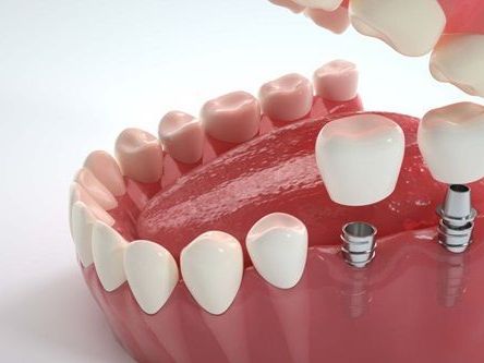 cheap-implant-in-northeast-philadelphia