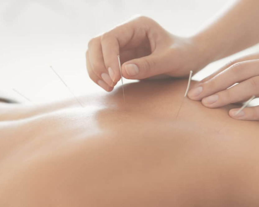 pain-management-acupuncture-in-nyc-back-neck-sciatica-relief