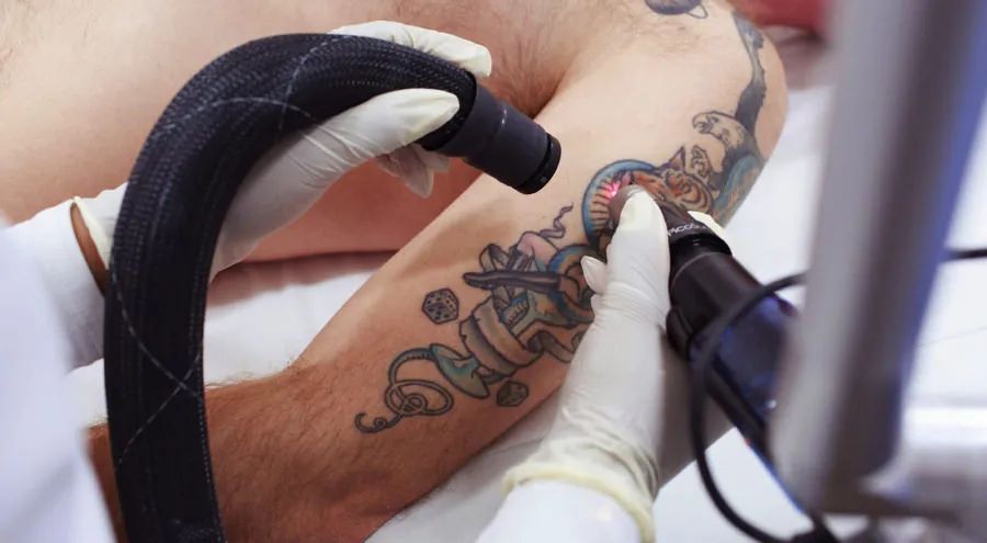 best-way-to-remove-tattoo-in-mckinney-premier-tattoo-big-0