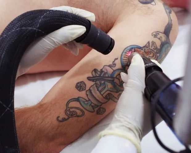 best-way-to-remove-tattoo-in-mckinney-premier-tattoo