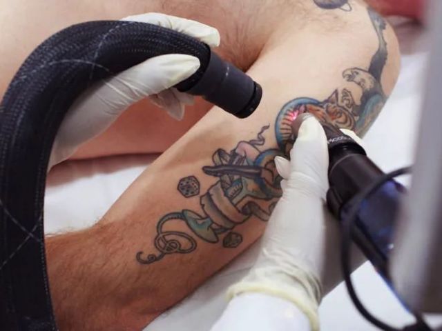 best-way-to-remove-tattoo-in-mckinney-premier-tattoo