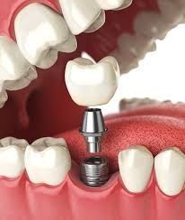 how-to-maintain-your-dental-implants-in-manhattan-big-0