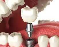 how-to-maintain-your-dental-implants-in-manhattan