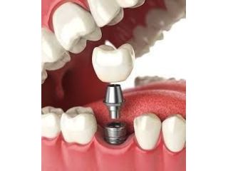 how-to-maintain-your-dental-implants-in-manhattan-small-0