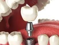 how-to-maintain-your-dental-implants-in-manhattan