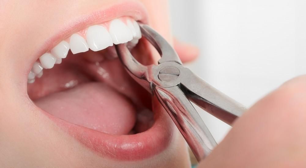 single-tooth-extraction-procedure-pinefield-dental-big-0