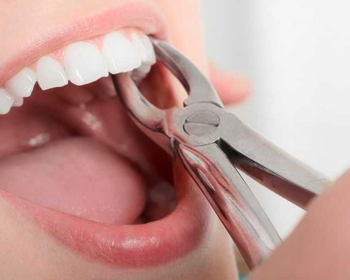 single-tooth-extraction-procedure-pinefield-dental
