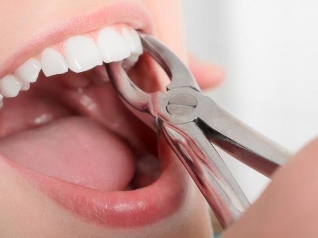 single-tooth-extraction-procedure-pinefield-dental