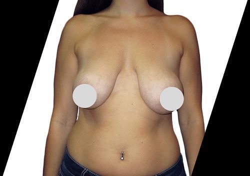 are-there-any-risks-or-side-effects-of-breast-reduction-big-0