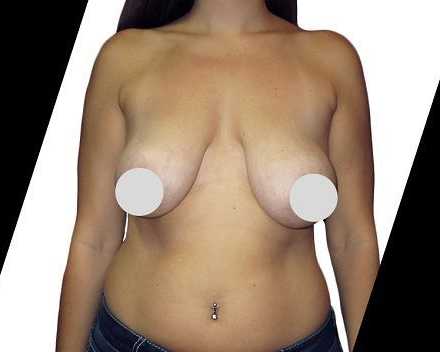 are-there-any-risks-or-side-effects-of-breast-reduction