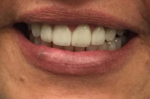 restore-damaged-teeth-with-porcelain-crowns-in-chandler-big-0