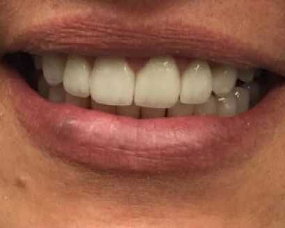 restore-damaged-teeth-with-porcelain-crowns-in-chandler