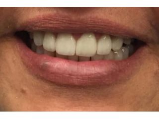restore-damaged-teeth-with-porcelain-crowns-in-chandler-small-0
