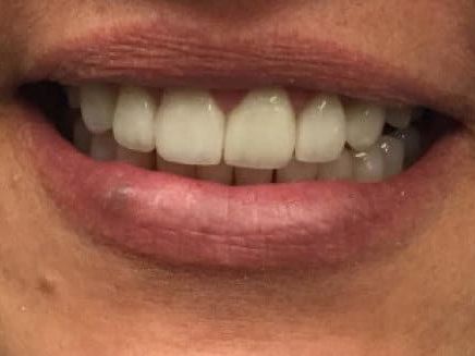 restore-damaged-teeth-with-porcelain-crowns-in-chandler