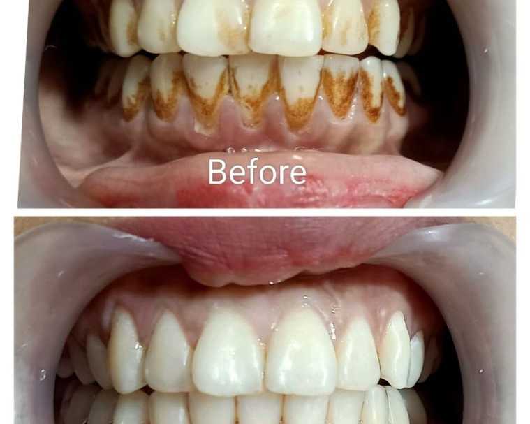 trusted-teeth-whitening-clinic-in-dwarka-sector-19