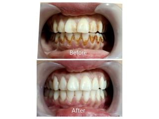 trusted-teeth-whitening-clinic-in-dwarka-sector-19-small-0