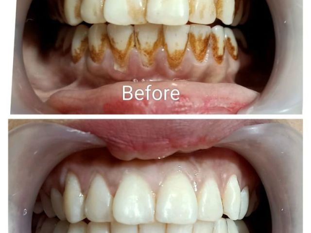 trusted-teeth-whitening-clinic-in-dwarka-sector-19