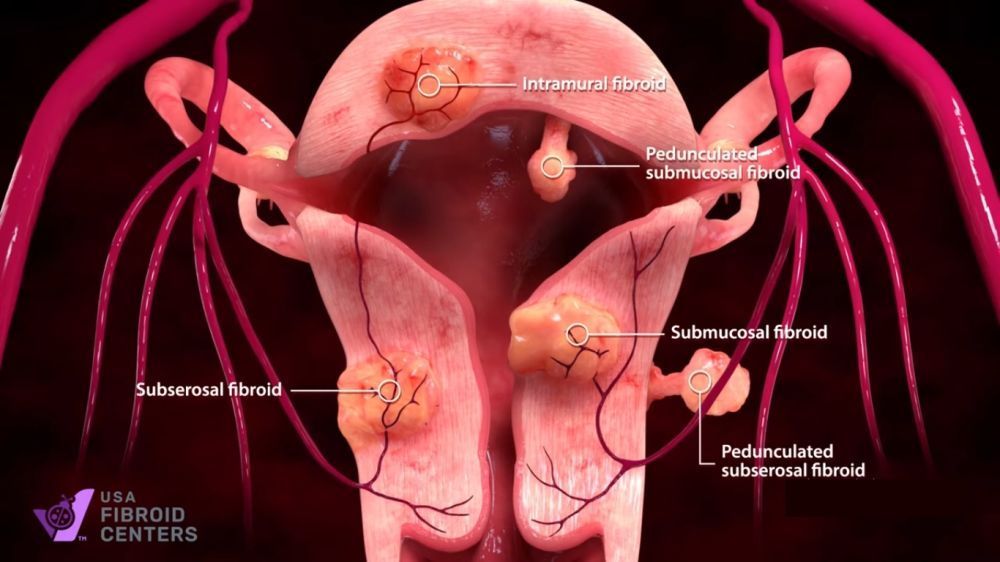 ufe-fibroid-treatment-near-me-usa-fibroid-centers-big-0