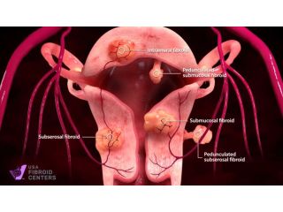 ufe-fibroid-treatment-near-me-usa-fibroid-centers-small-0