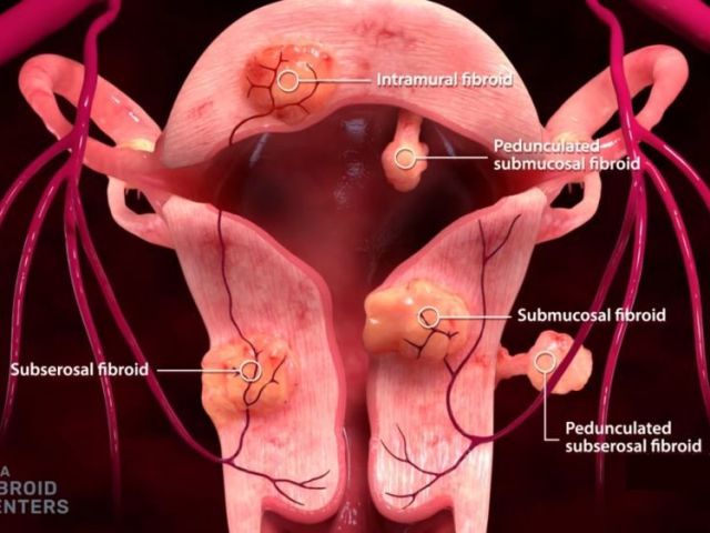 ufe-fibroid-treatment-near-me-usa-fibroid-centers