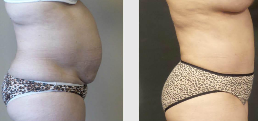 get-a-flatter-stomach-with-tummy-tuck-seattle-at-7485-big-1