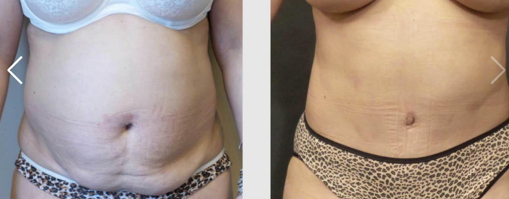 get-a-flatter-stomach-with-tummy-tuck-seattle-at-7485-big-0