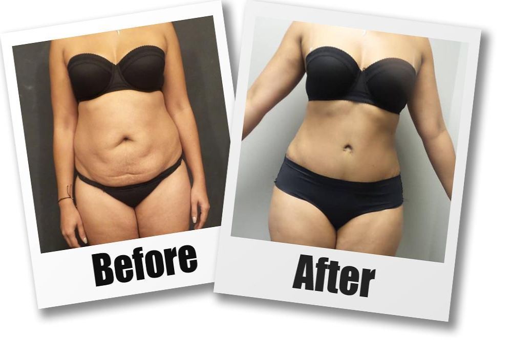 get-a-flatter-stomach-with-tummy-tuck-seattle-at-7485-big-2
