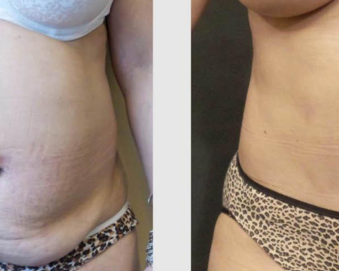 get-a-flatter-stomach-with-tummy-tuck-seattle-at-7485