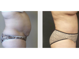 get-a-flatter-stomach-with-tummy-tuck-seattle-at-7485-small-1