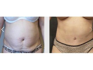 get-a-flatter-stomach-with-tummy-tuck-seattle-at-7485-small-0