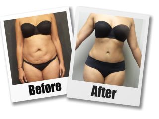 get-a-flatter-stomach-with-tummy-tuck-seattle-at-7485-small-2