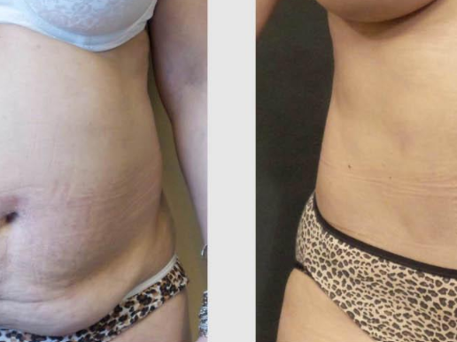 get-a-flatter-stomach-with-tummy-tuck-seattle-at-7485