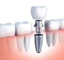 dental-implant-cost-big-0