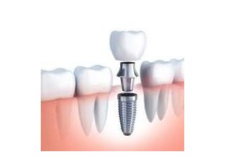 dental-implant-cost-small-0
