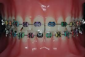 straighten-your-smile-with-expert-orthodontics-in-katy-tx-big-0