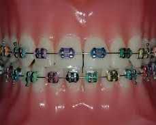 straighten-your-smile-with-expert-orthodontics-in-katy-tx