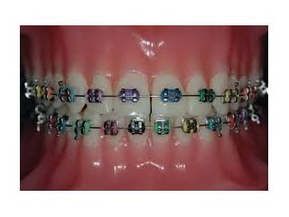 straighten-your-smile-with-expert-orthodontics-in-katy-tx-small-0