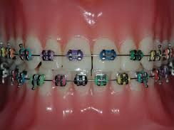 straighten-your-smile-with-expert-orthodontics-in-katy-tx