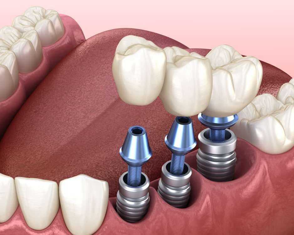 restore-your-smile-with-confidence