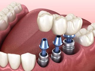 restore-your-smile-with-confidence-small-0