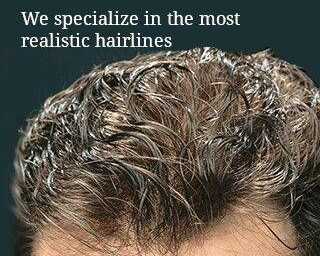 best-hair-systems-for-men-for-a-natural-hairline