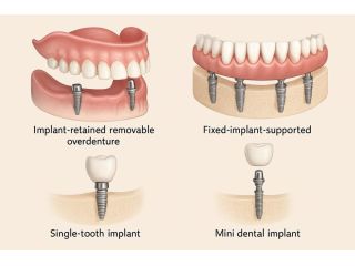 how-painful-is-a-denture-implant-procedure-small-0
