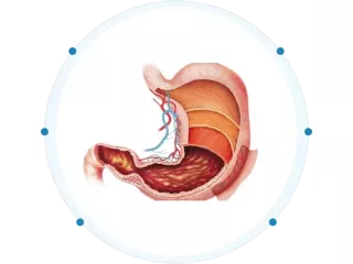 alhl-alfaaal-lltkhls-mn-alsmn-othsyn-god-alhya-small-0