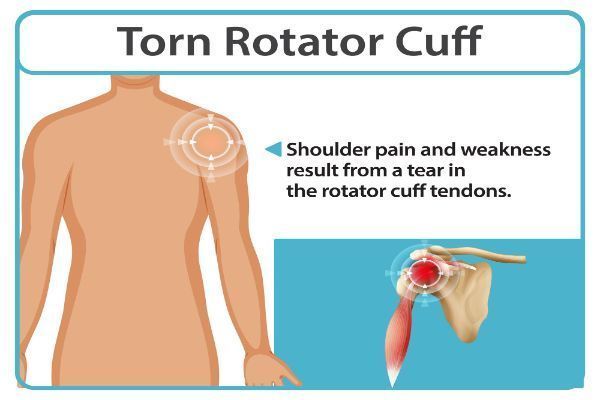 rotator-cuff-specialists-and-shoulder-injury-treatment-big-0