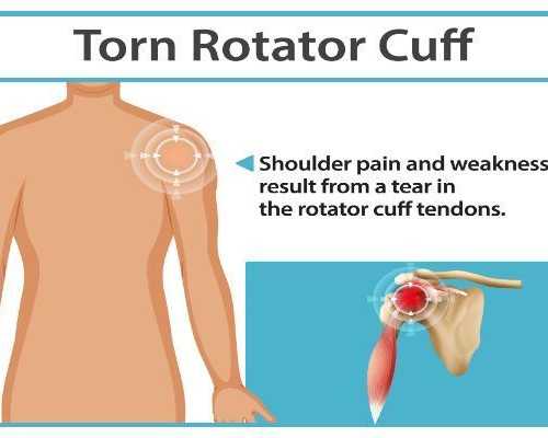 rotator-cuff-specialists-and-shoulder-injury-treatment